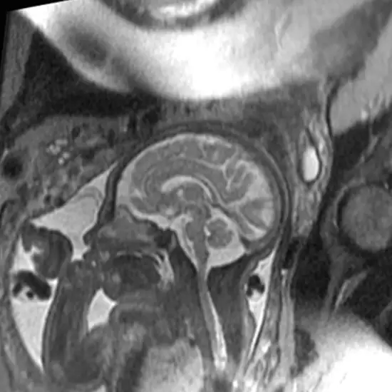 MRI Fetus